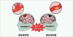 氫氣防治腦梗腦中風(fēng)，中老年人越早吸氫越好！