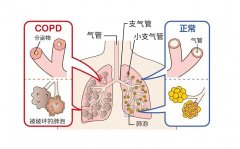 吸入氫氣對慢性低氧性肺動脈高壓的影響