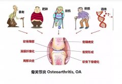 氫氣飽和等滲鹽水腹腔注射治療兔創(chuàng)傷性關(guān)節(jié)炎的實驗研究
