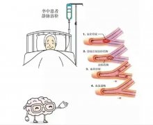 氫動力微馬達(dá)在急性缺血性腦卒中的精準(zhǔn)改善研究