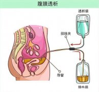 分子氫對(duì)腹膜透析患者的臨床研究