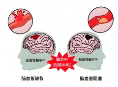 臨床證實日常飲用氫水有助中風(fēng)康復(fù)
