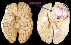 高濃度分子氫：一種潛在的膠質(zhì)瘤克星