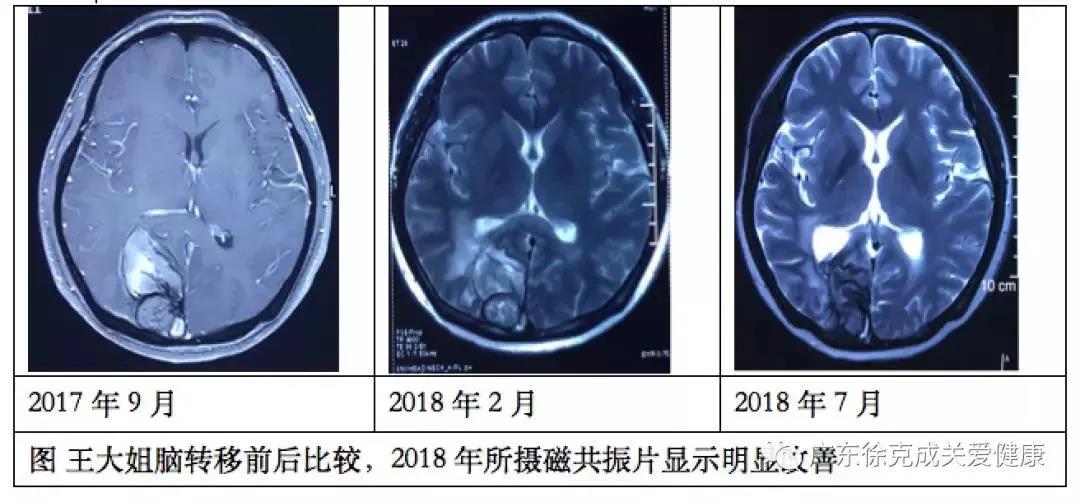 臨床報告顯示｜吸氫后，肺癌腦轉(zhuǎn)移完全消失了。