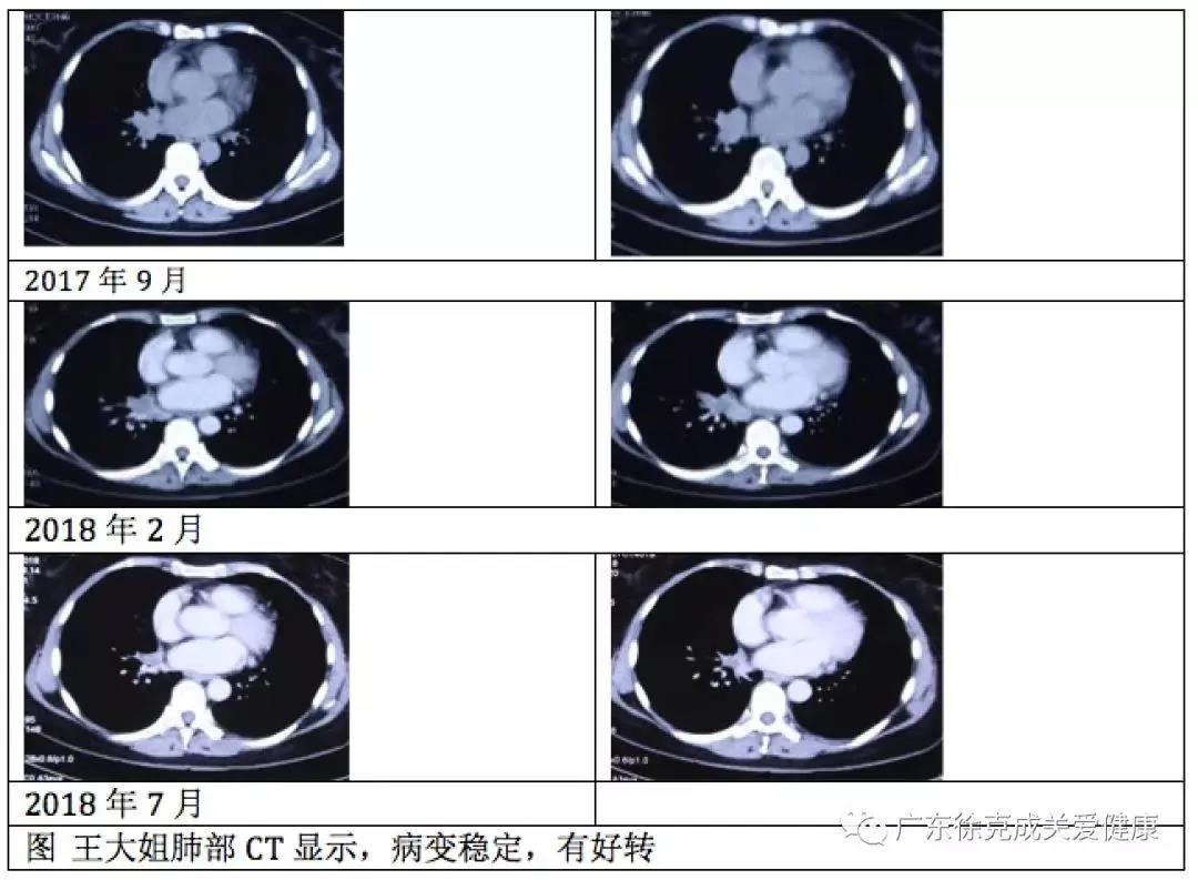 臨床報告顯示｜吸氫后，肺癌腦轉(zhuǎn)移完全消失了。