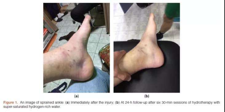 氫水改善足球職業(yè)運動員軟組織損傷【案例】