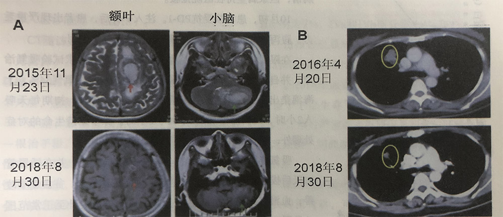 右肺上葉腺癌cT2aN2M1b IV期伴腦轉(zhuǎn)移