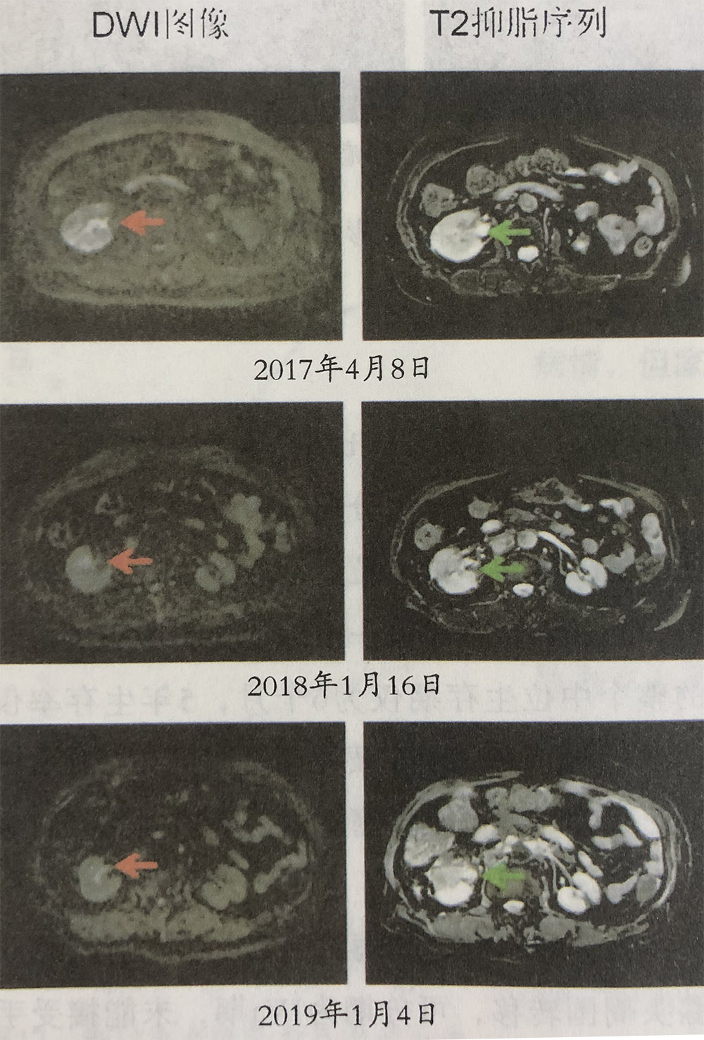 輸尿管腺癌的氫氣輔助作用，吸氫前后比較