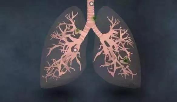 氫案例|肺癌患者家屬的陪護日記:吸氫是應對預后的有效手段