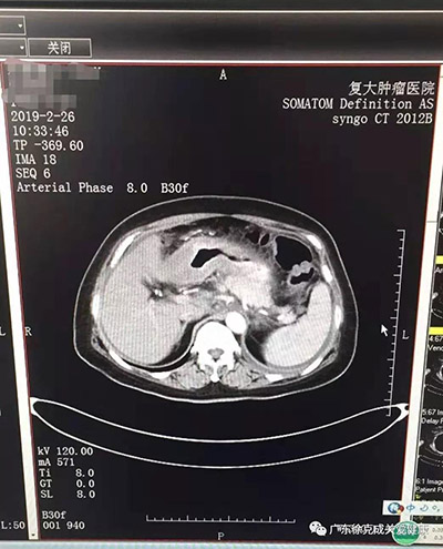 她的腫瘤神奇消失，誰的功勞？