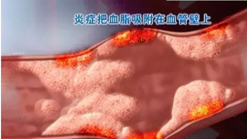中風(fēng)危險(xiǎn)知多少？