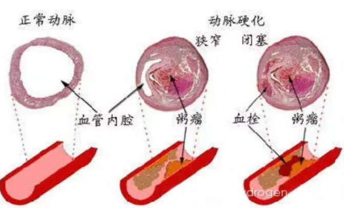 動脈硬化也存在氧化損傷，也是炎癥性疾病，氫氣有預防動脈硬化可能