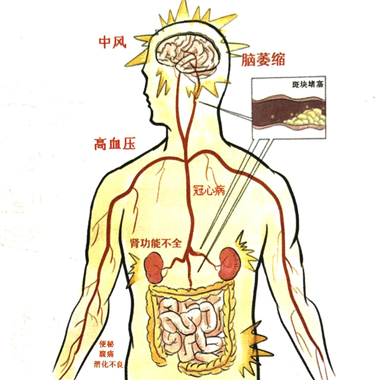 動(dòng)脈粥樣硬化的主要危害