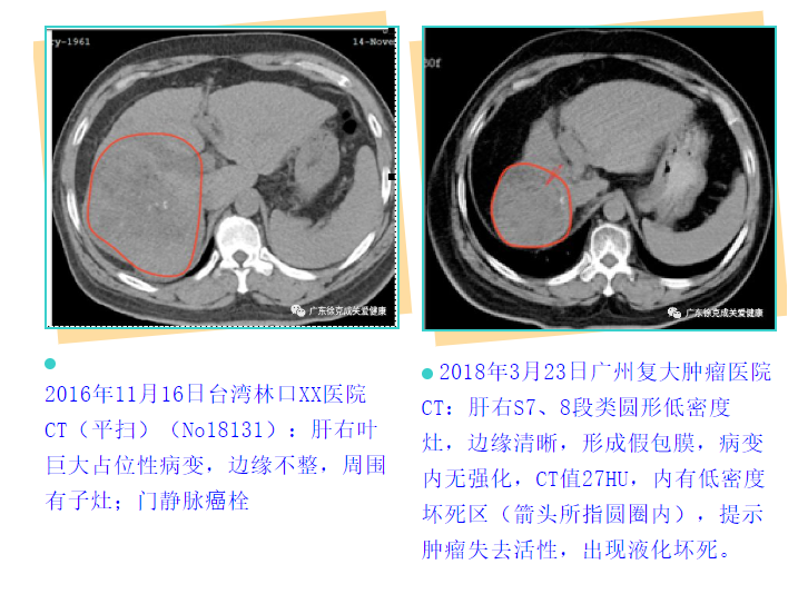 吸氫控癌病人回訪｜他說：五年后會(huì)向醫(yī)生說出這個(gè)“秘密”