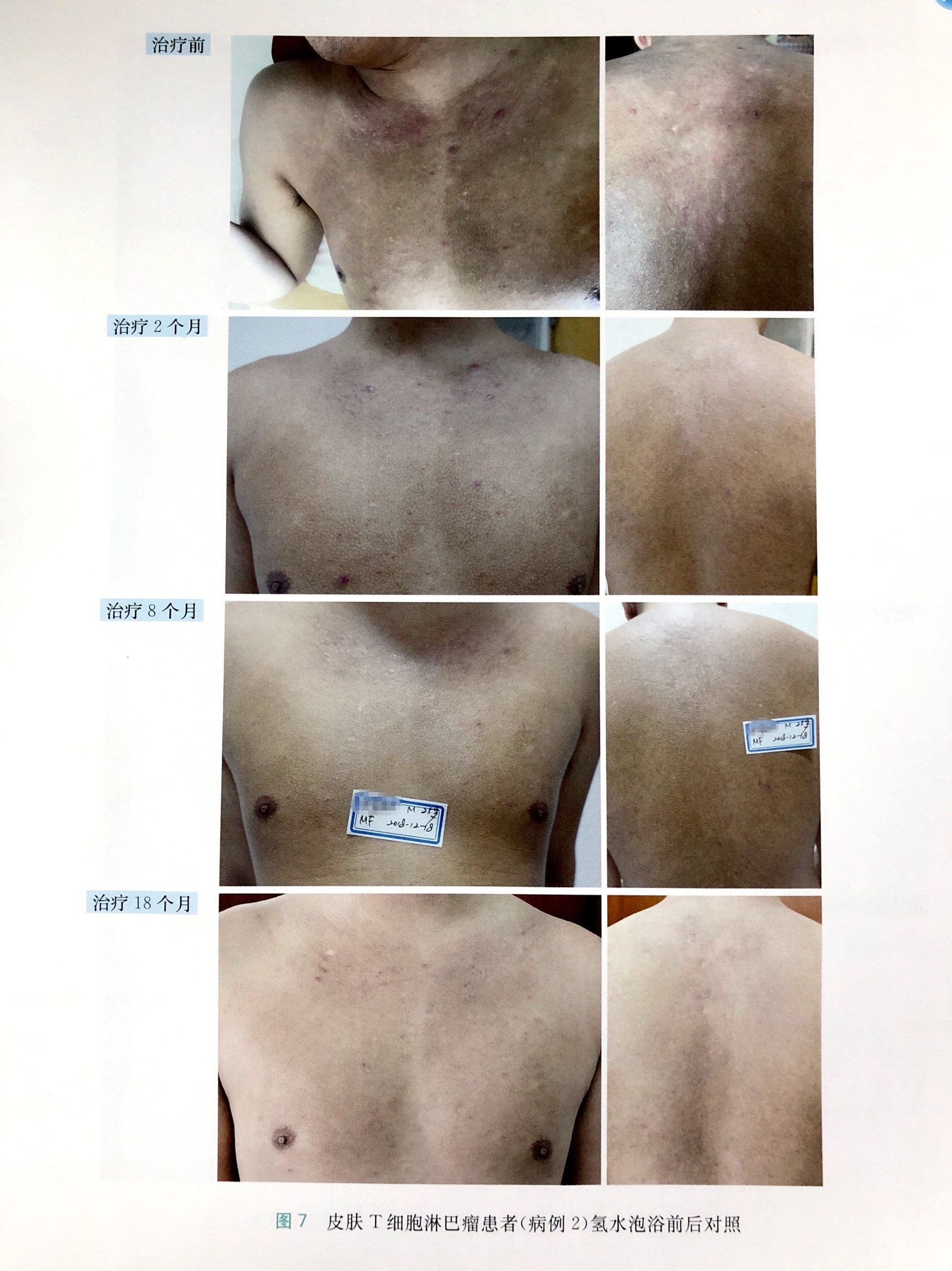 皮膚T細(xì)胞淋巴瘤改善病例二（蕈樣肉芽腫）