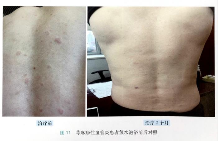 蕁麻疹性血管炎的改善病例