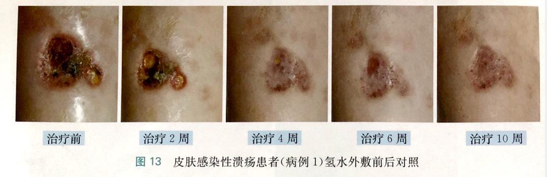 2個(gè)皮膚感染性潰瘍的改善病例