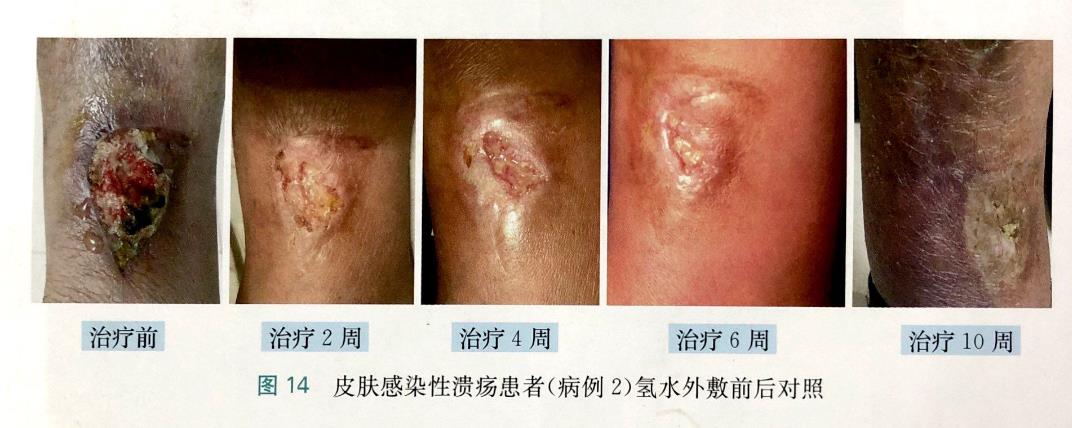 2個(gè)皮膚感染性潰瘍的改善病例