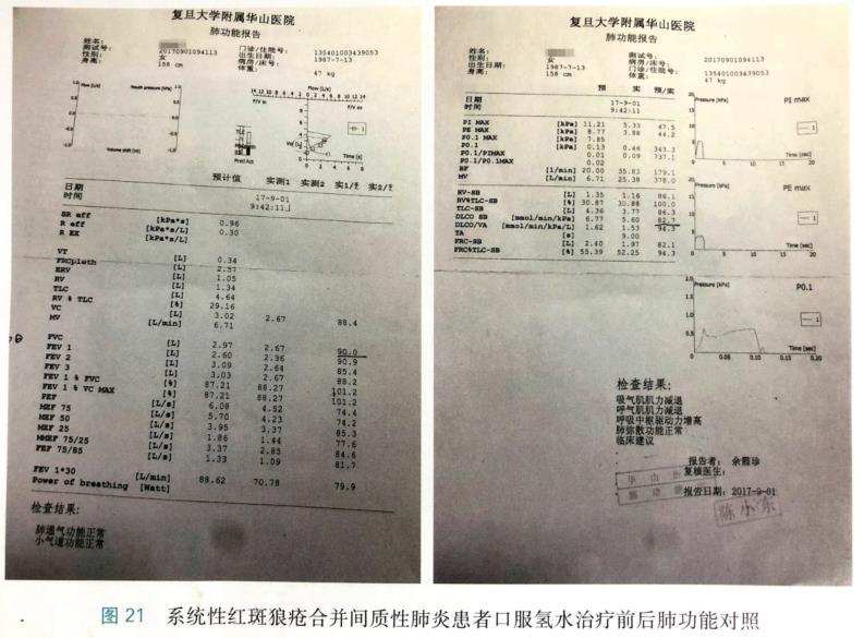 氫氣改善結(jié)締組織病相關(guān)間質(zhì)性肺疾病