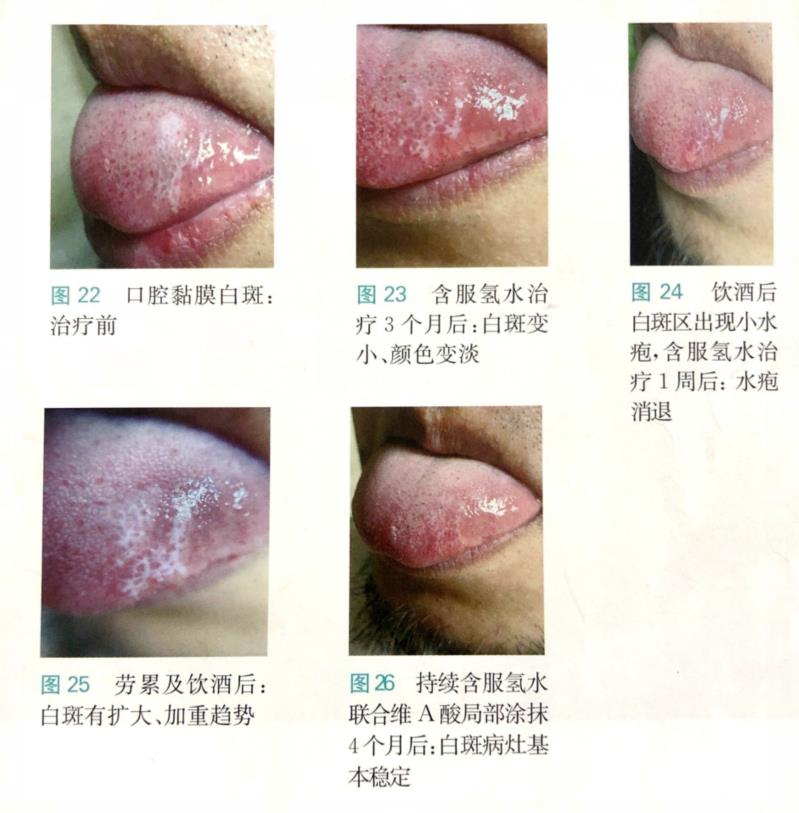 氫氣改善口腔黏膜白斑病例分享