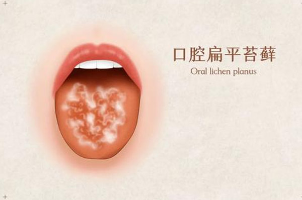 口腔扁平苔蘚是怎么引起的 氫氣水或可清潔口腔 清新口氣