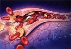 脂蛋白氧化是動脈硬化的關鍵，氫氣顯效要持續(xù)要足量