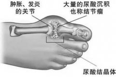 氫水對高尿酸血癥有調(diào)節(jié)作用