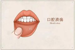 有一種痛叫口腔潰瘍！飲用富氫水靠譜？！