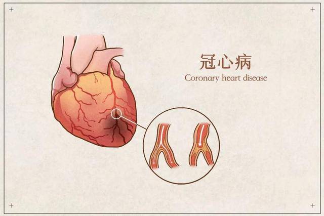 速效救心丸 冠心病常備良藥,正確服法學(xué)起來