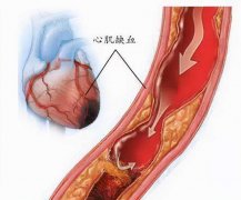 氫氣、富氫水在臨床疾病中的應(yīng)用綜述