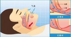 氫氣吸入治療呼吸暫停綜合征