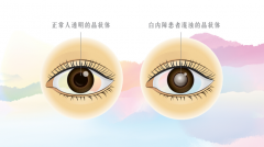 氫分子對白內(nèi)障的作用和臨床研究