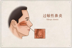 過敏性鼻炎吸氫竟然有效！