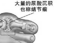 【臨床】301醫(yī)院臨床研究證實(shí)｜氫水對(duì)痛風(fēng)有明顯療效